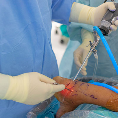 Keyhole Ankle Surgery In Guntur