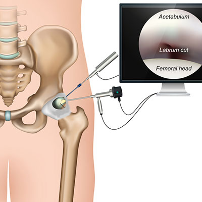 Hip Arthroscopy In Guntur