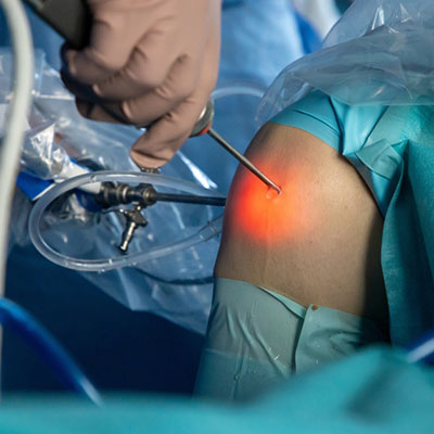 Keyhole Knee Surgery In Guntur